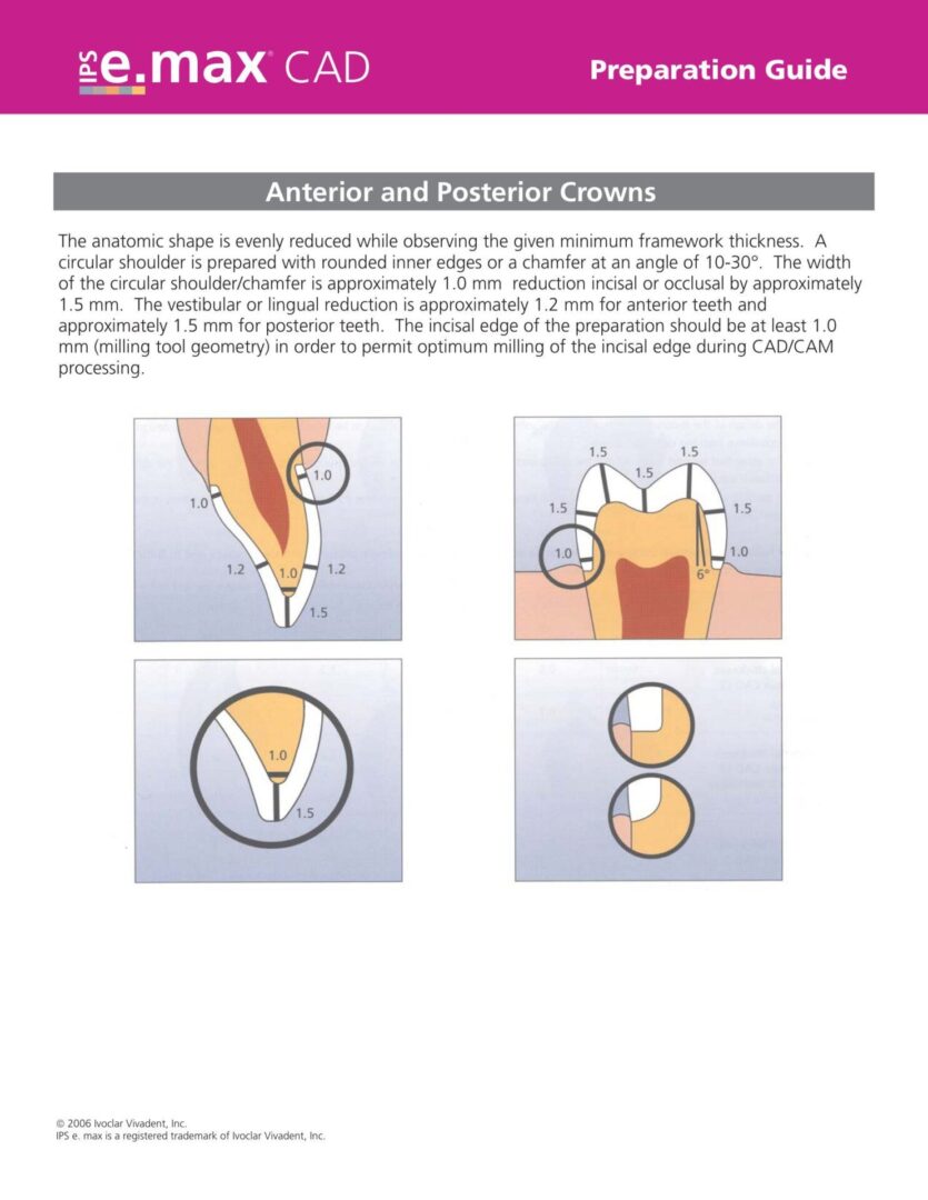 An Anterior and Posterior Crowns With Diagrams